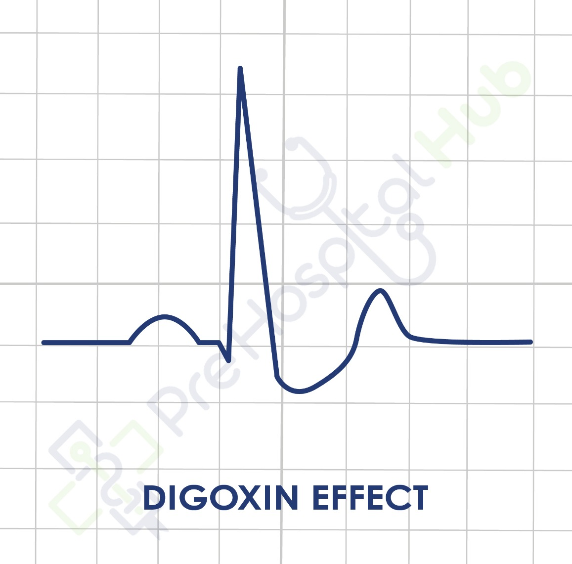 Digoxin Effect ECG