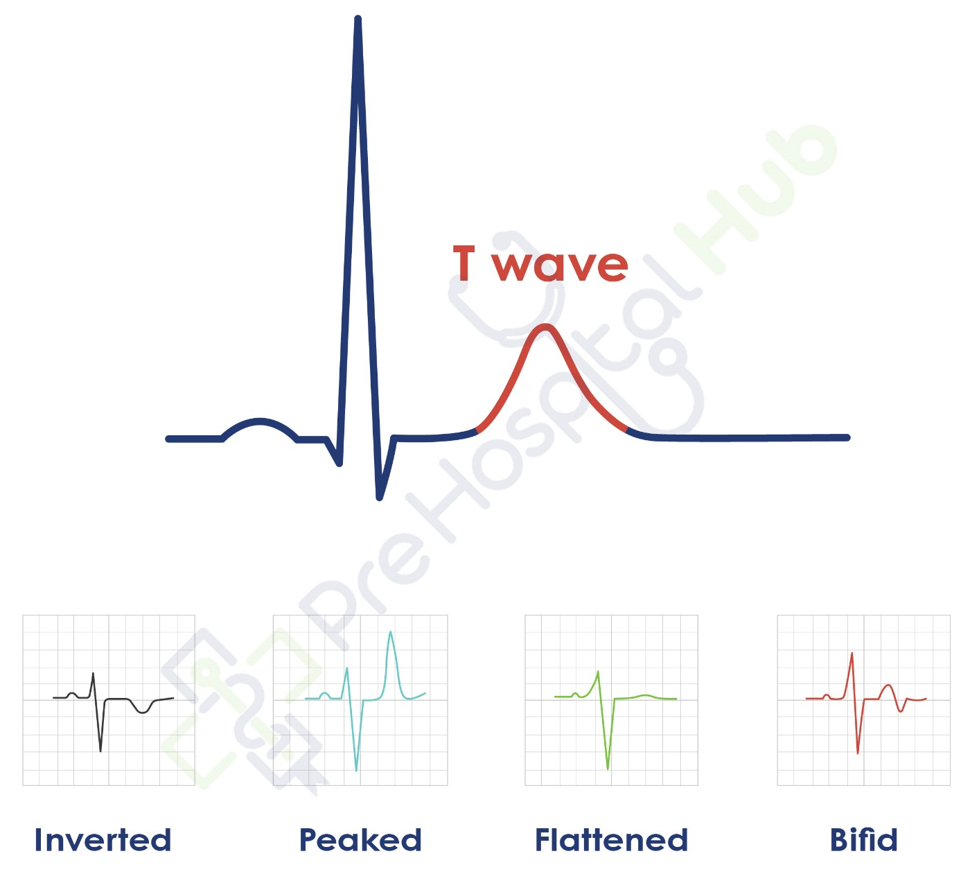 T Wave Abnormalities