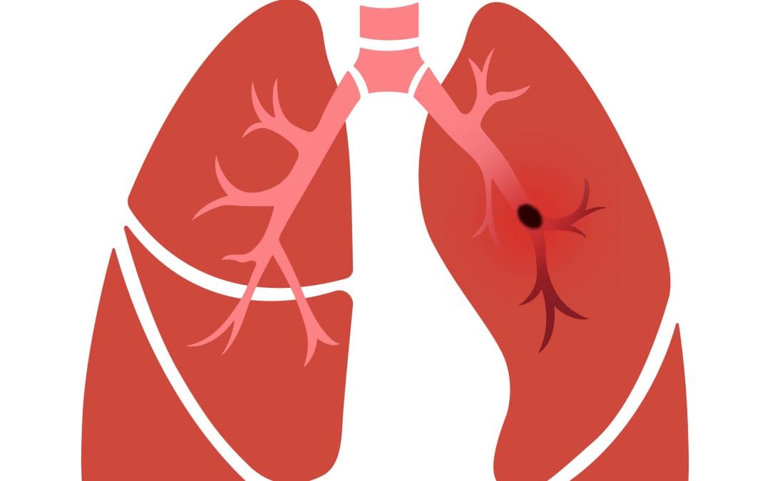 Pulmonary Embolism (PE)